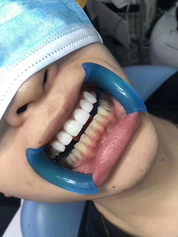 河南牙齿贴面优缺点 欢迎咨询 郑州牙美康生物科技供应