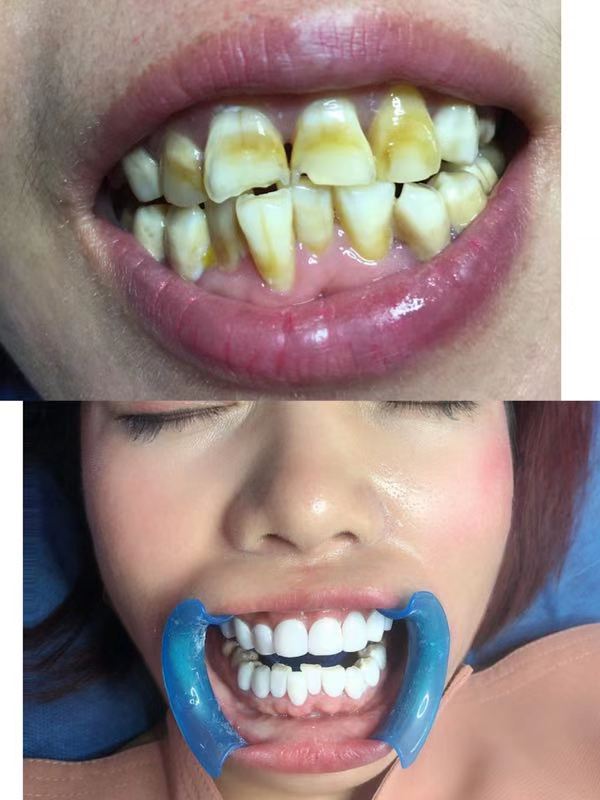 焦作牙齿贴面流程 来电咨询 郑州牙美康生物科技供应