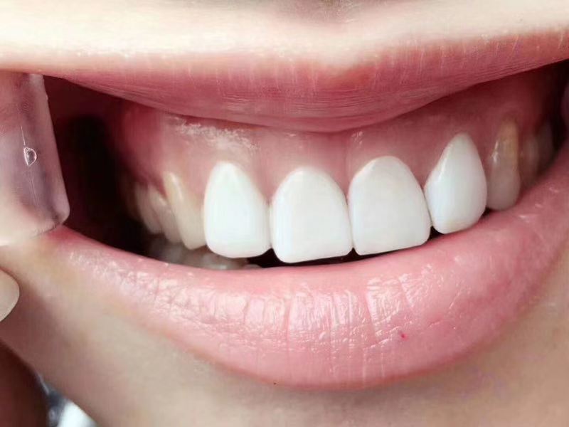河南牙齿贴面的副作用 来电咨询 郑州牙美康生物科技供应