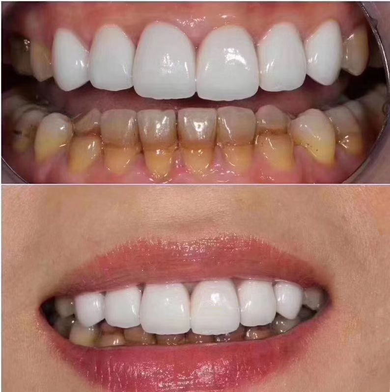 鹤壁牙齿贴面能用多久 来电咨询 郑州牙美康生物科技供应