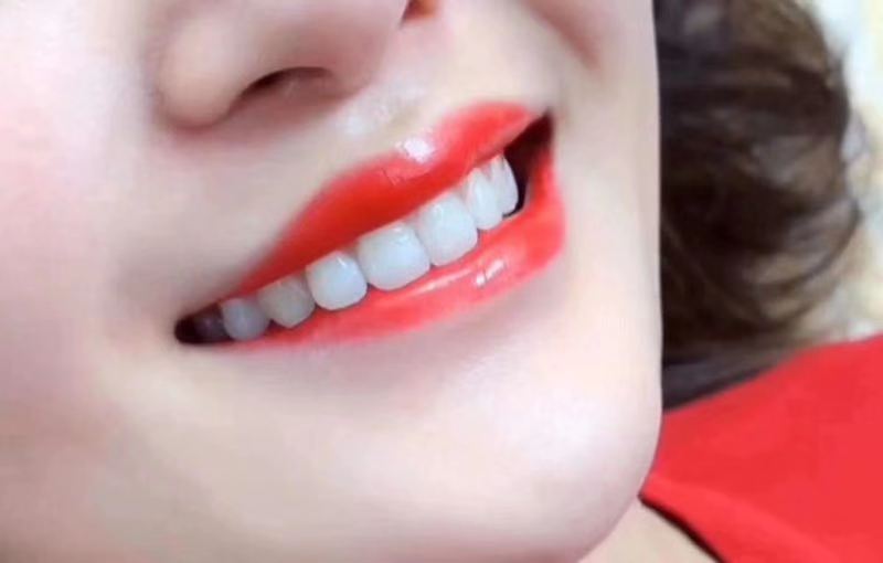 信阳牙齿贴面制作 欢迎来电 郑州牙美康生物科技供应