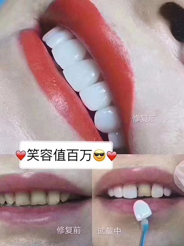 濮阳什么是牙齿贴面 欢迎咨询 郑州牙美康生物科技供应